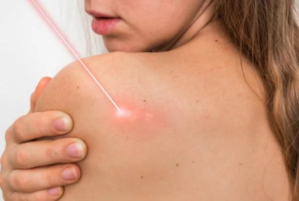 Dr Simone Matousek Plastic Reconstructive and Cosmetic Surgeon scar improvement