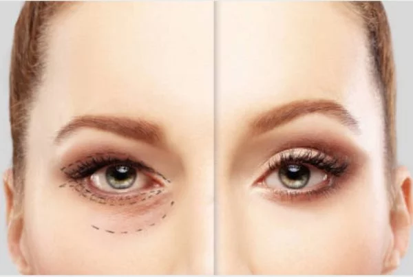 Dr Simone Matousek Plastic, Reconstructive and Cosmetic Surgeon eyelid lift