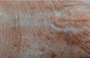Dr-Simone-Matousek-plastic-surgeon-skin-cancer-treatment