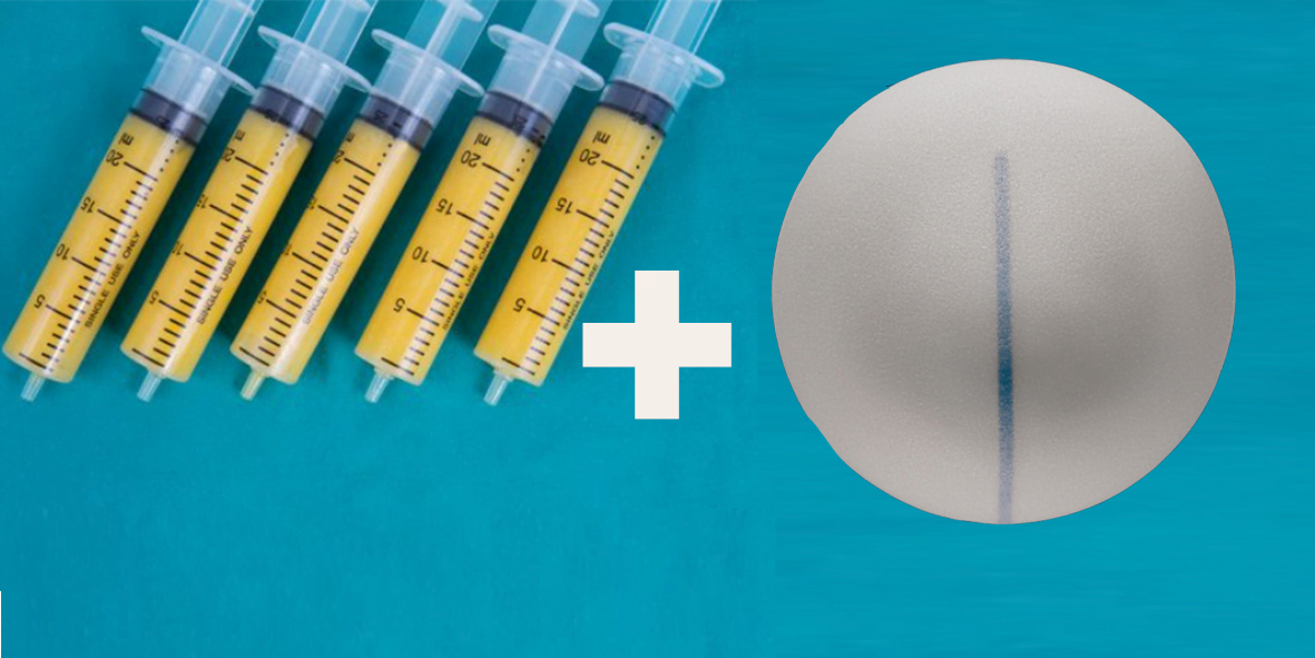 Hybrid breast augmentation