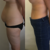 Abdominoplasty-Sydney