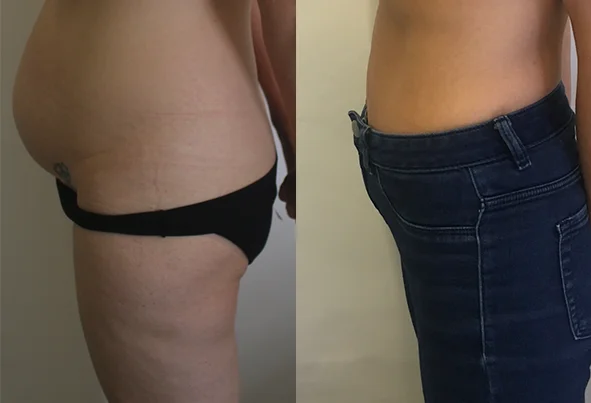 Abdominoplasty-Sydney