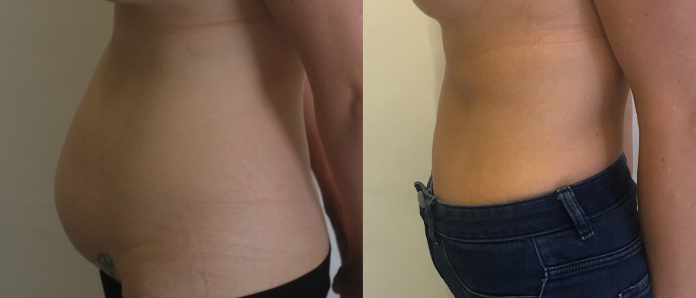 New Medicare item number for tummy tuck or abdominoplasty